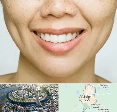 عمل چال گونه در بابل
