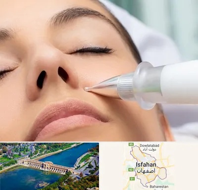 پلاسما جت بینی در اصفهان