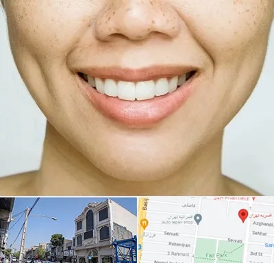 عمل چال گونه در افسریه 