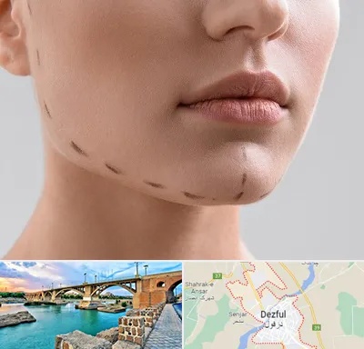 عمل زاویه فک در دزفول