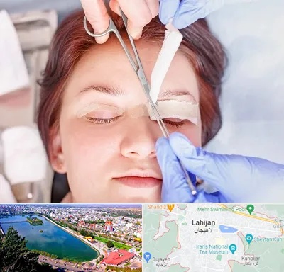 جراحی پلک افتاده در لاهیجان