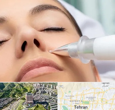 پلاسما جت بینی در شمال تهران 