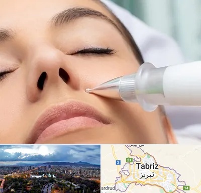 پلاسما جت بینی در تبریز