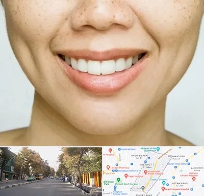 عمل چال گونه در شریعتی 