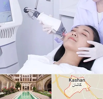 وایتنینگ در کاشان