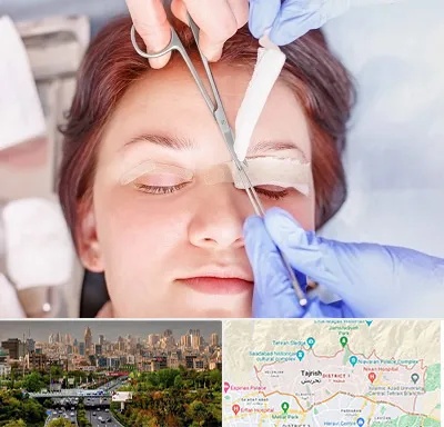 جراحی پلک افتاده در منطقه 1 تهران 
