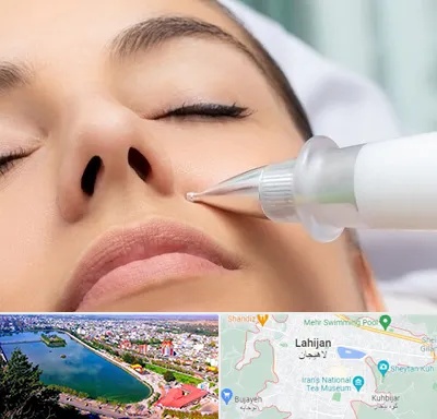 پلاسما جت بینی در لاهیجان