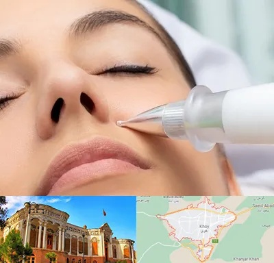 پلاسما جت بینی در خوی