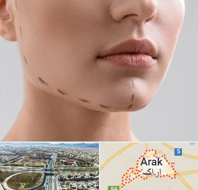 عمل زاویه فک در اراک