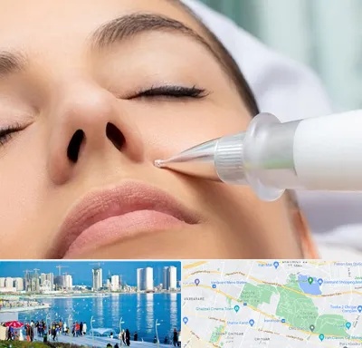 پلاسما جت بینی در چیتگر 