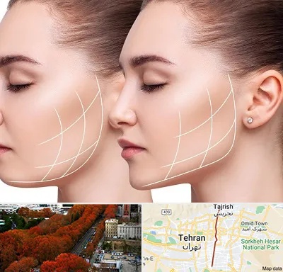 جراحی بوکال فت در ولیعصر 