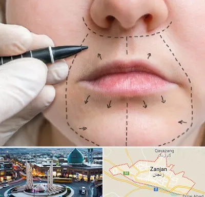 عمل سانترال لب در زنجان