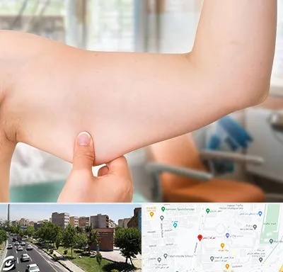 براکیوپلاستی در شهرک آزمایش 