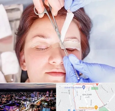 جراحی پلک افتاده در گلسار رشت 