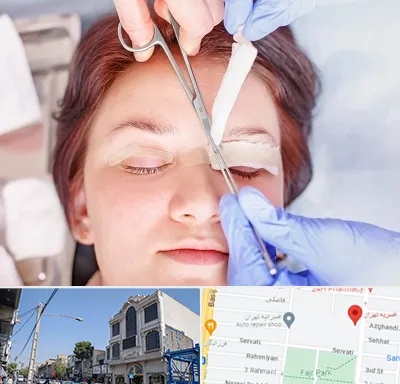 جراحی پلک افتاده در افسریه 