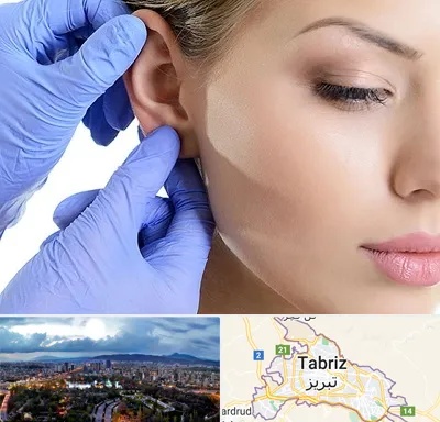 اتوپلاستی در تبریز