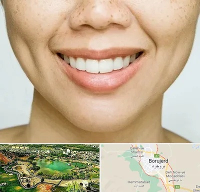 عمل چال گونه در بروجرد