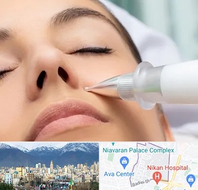 پلاسما جت بینی در آجودانیه 