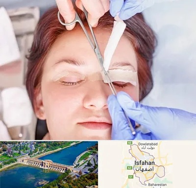 جراحی پلک افتاده در اصفهان