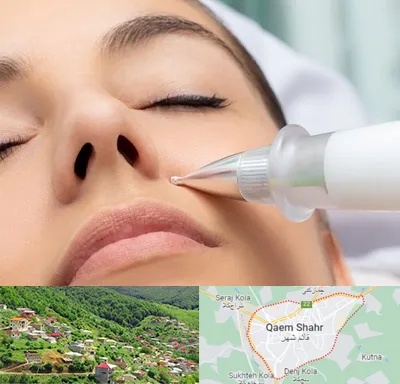 پلاسما جت بینی در قائم شهر