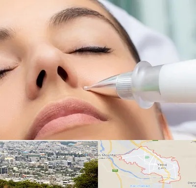 پلاسما جت بینی در یاسوج