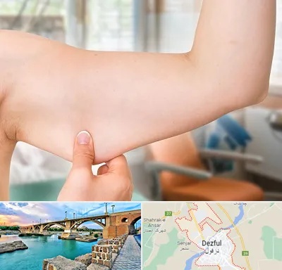 براکیوپلاستی در دزفول
