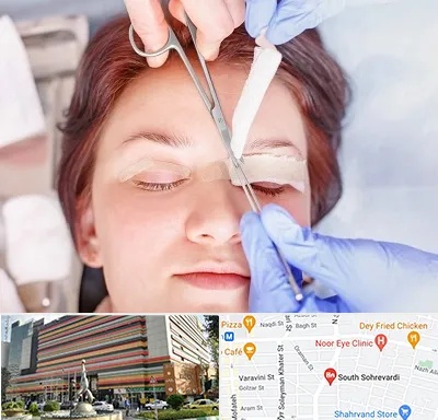 جراحی پلک افتاده در سهروردی 