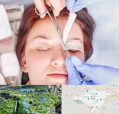 جراحی پلک افتاده در بجنورد