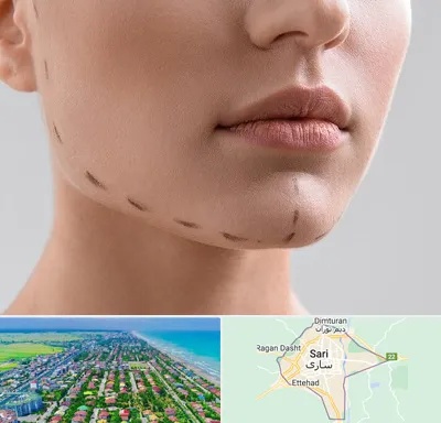 عمل زاویه فک در ساری