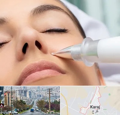 پلاسما جت بینی در گوهردشت کرج 