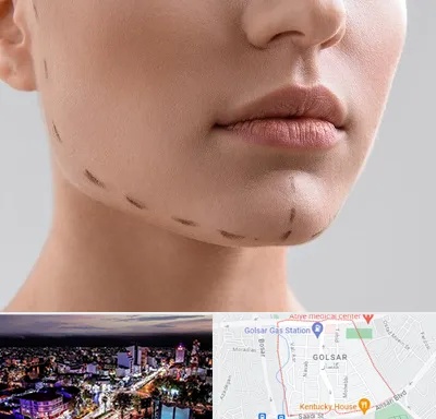 عمل زاویه فک در گلسار رشت 