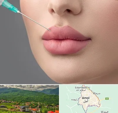 کلینیک ژل لب روسی در آمل