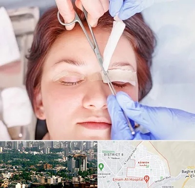 جراحی پلک افتاده در عظیمیه کرج 