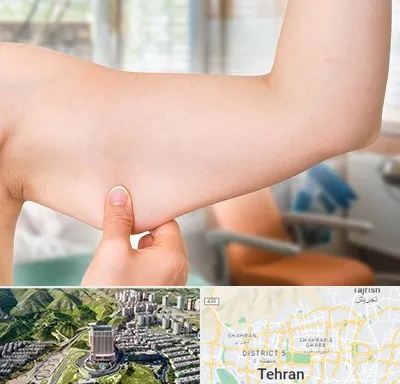 براکیوپلاستی در شمال تهران 