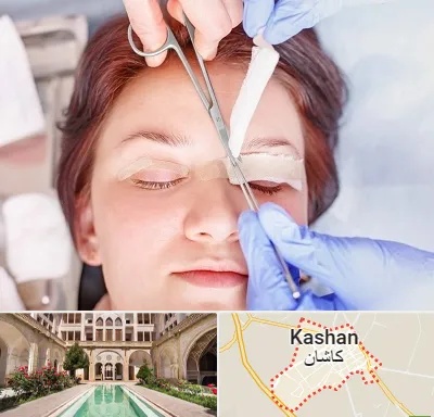 جراحی پلک افتاده در کاشان