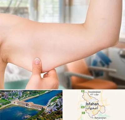 براکیوپلاستی در اصفهان