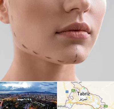 عمل زاویه فک در تبریز