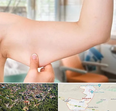 براکیوپلاستی در دماوند