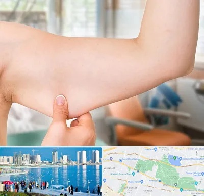 براکیوپلاستی در چیتگر 
