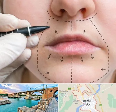 عمل سانترال لب در دزفول