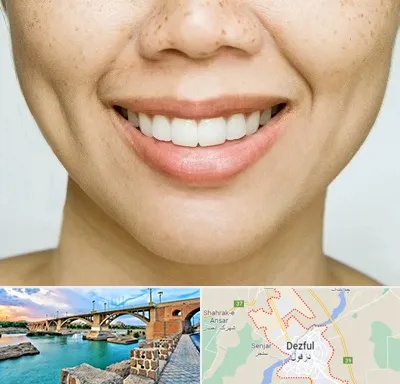 عمل چال گونه در دزفول