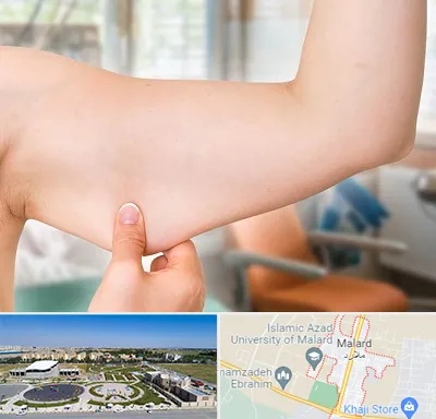 براکیوپلاستی در ملارد