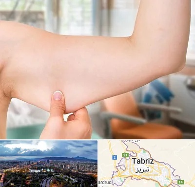 براکیوپلاستی در تبریز