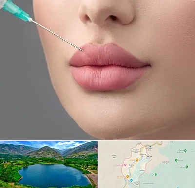 کلینیک ژل لب روسی در رودبار