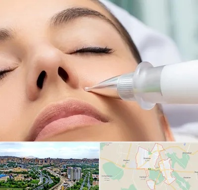 پلاسما جت بینی در شهریار