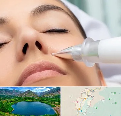 پلاسما جت بینی در رودبار