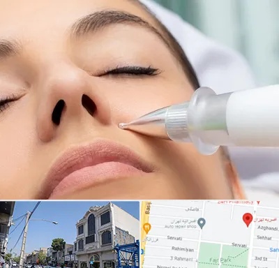 پلاسما جت بینی در افسریه 