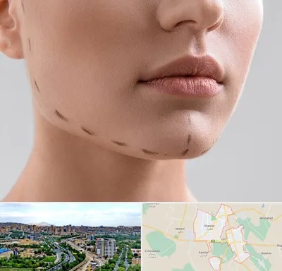 عمل زاویه فک در شهریار