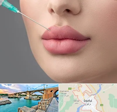 کلینیک ژل لب روسی در دزفول
