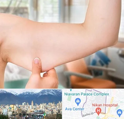 براکیوپلاستی در آجودانیه 